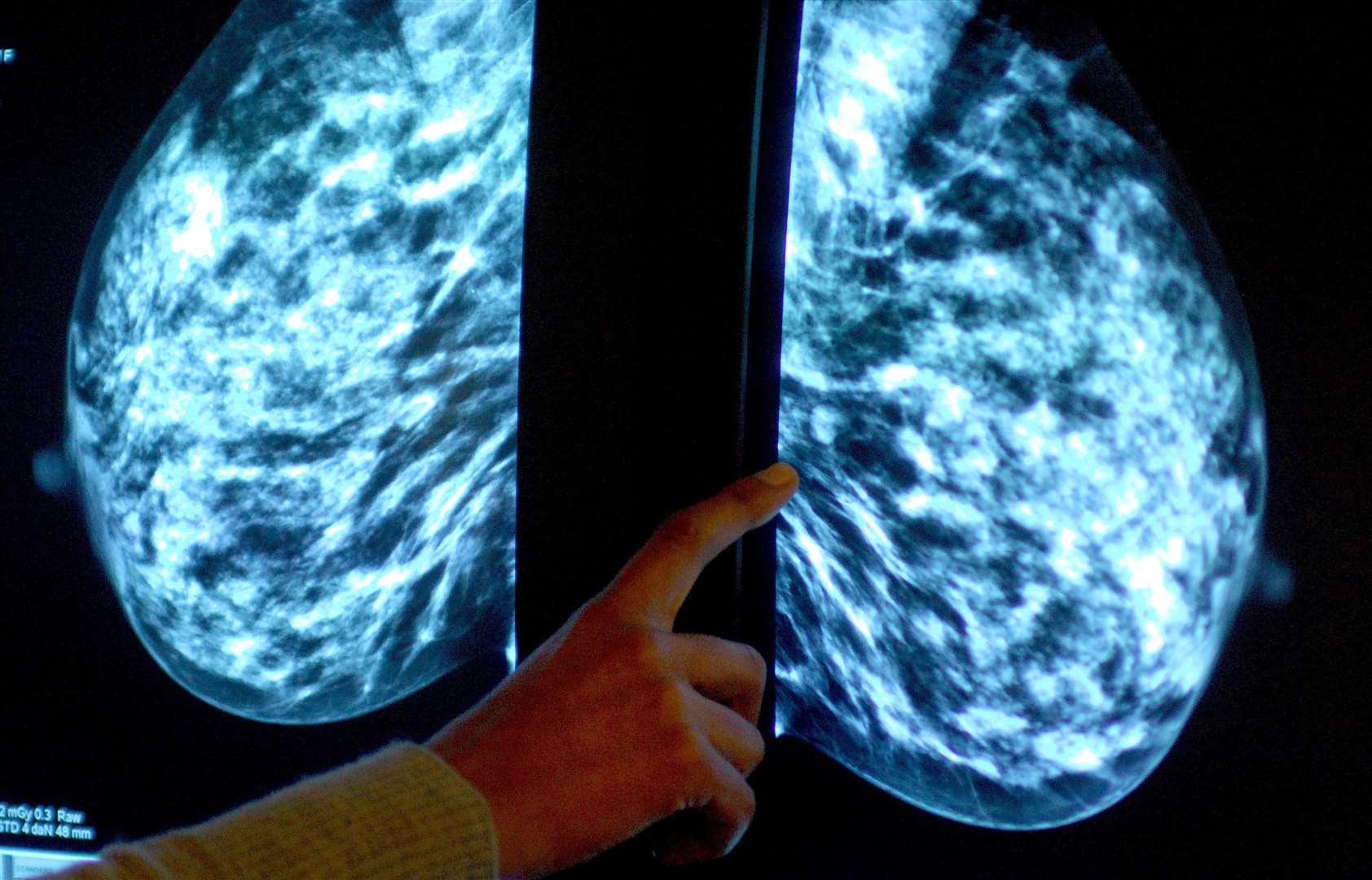 A mammogram showing female breasts in order check for breast cancer (Rui Vieira/PA)