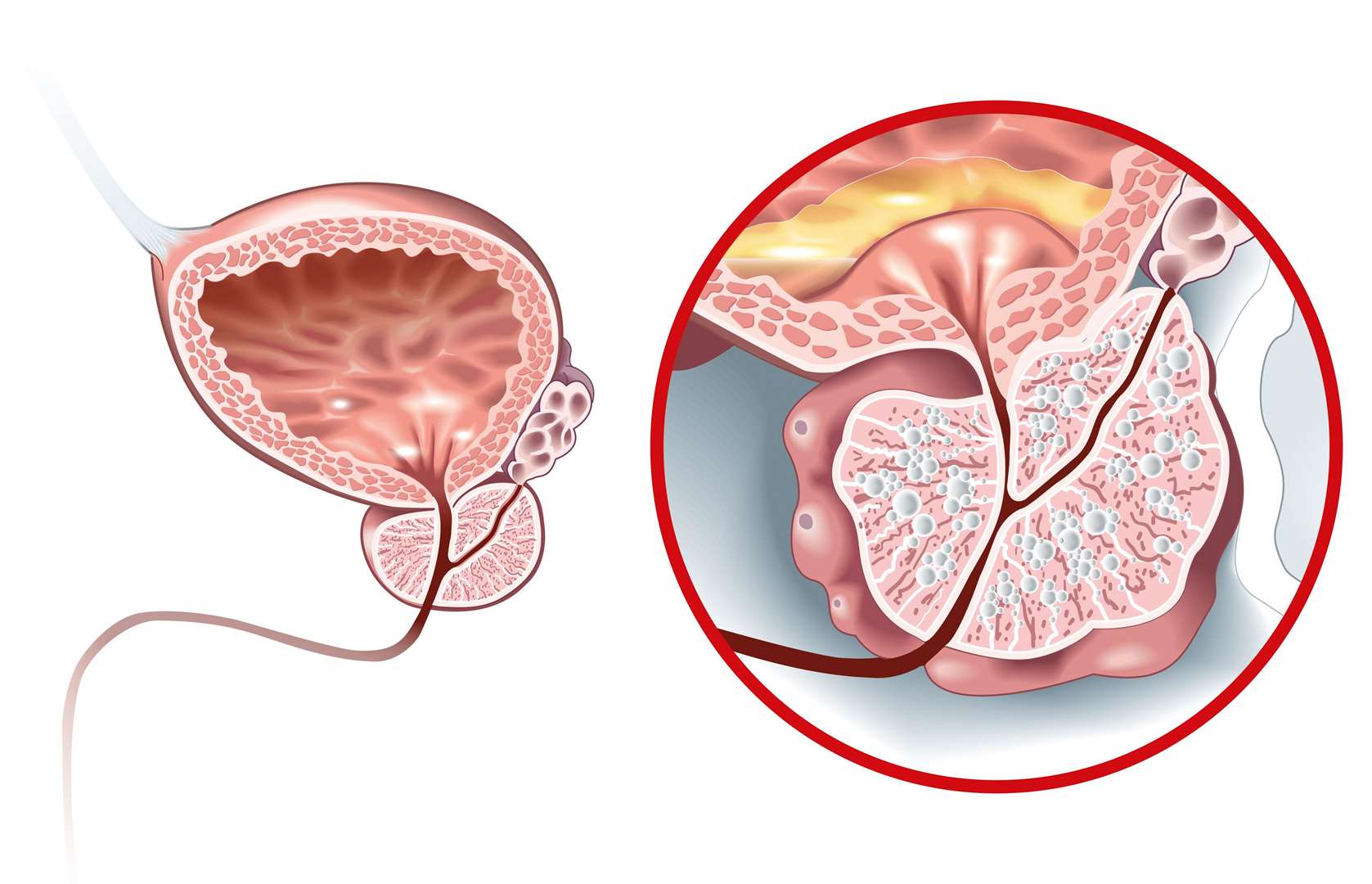 Illustration showing a healthy prostate, left, and benign prostate enlargement (Alamy/PA)