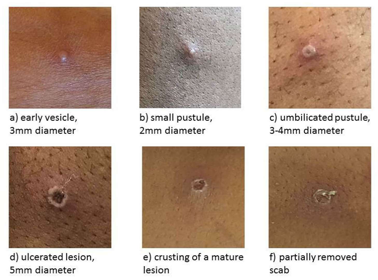 The disease leads to sores, blisters and scabs on the skin (PA)