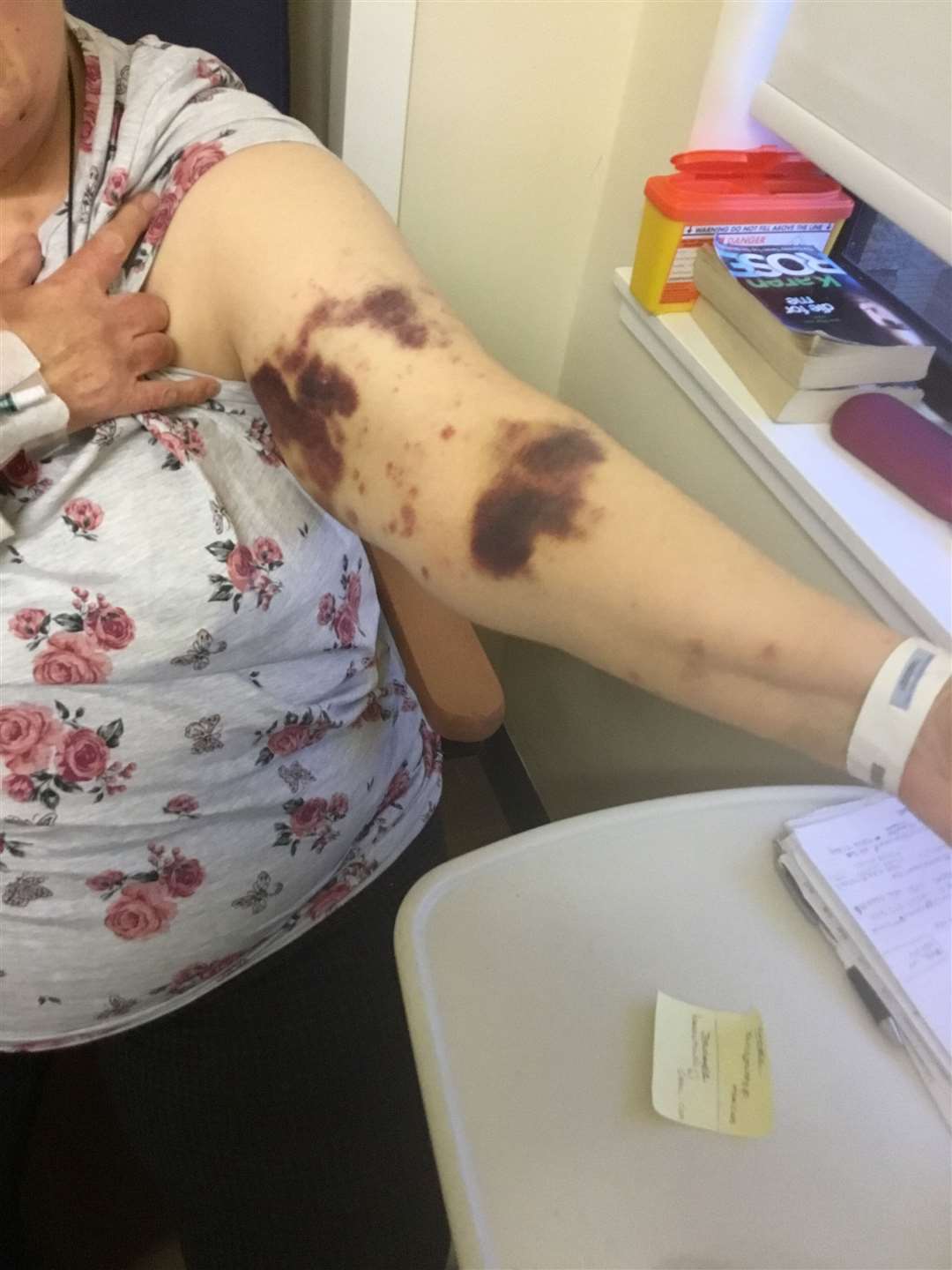 Some of her bruising before treatment.